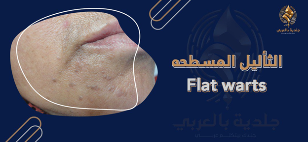 مرض الثأليل المسطحه (Flat warts)، أعراضه وكيفية علاجه والوقاية منه