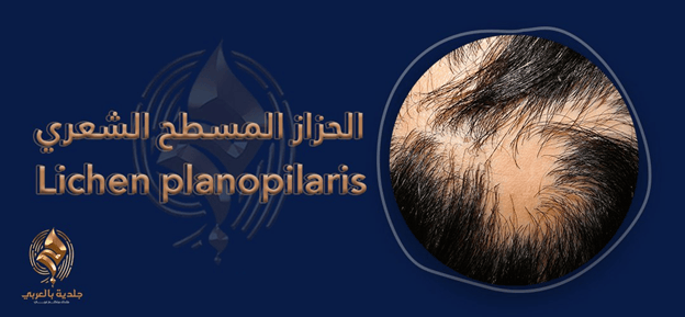 lichen planopilaris الحزاز المسطح الشعرى /حزاز وتأثيره في فروة الرأس