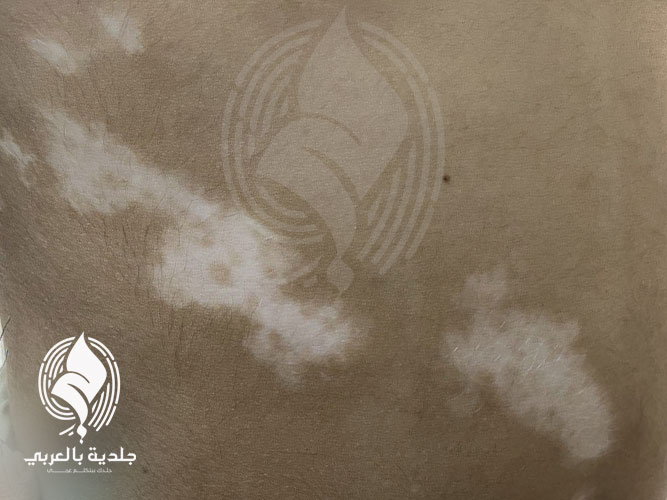 اعراض البهاق عند الكبار