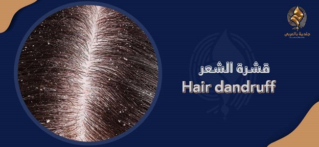 ما الذي يجب معرفته عن أنواع القشره بالشعر وأساليب العلاج؟