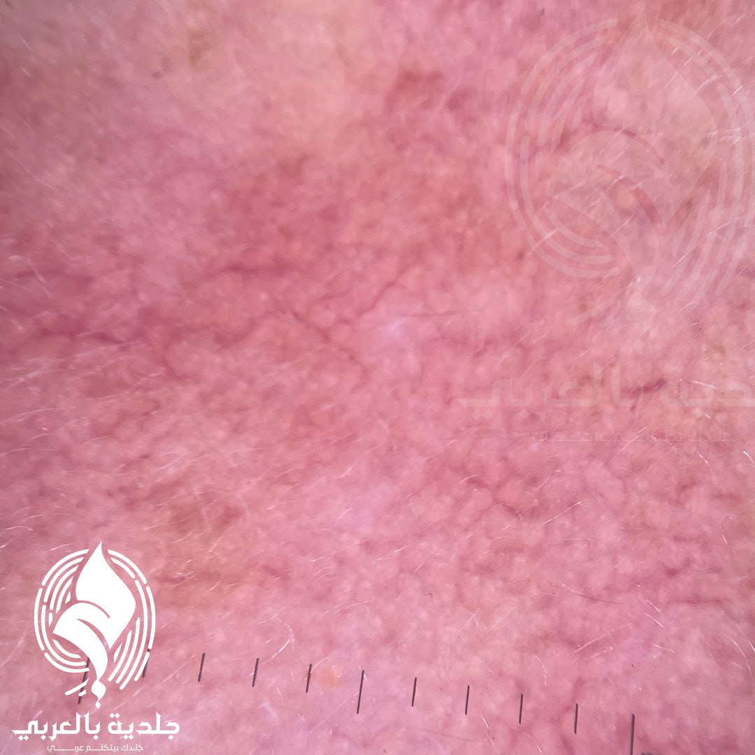 التشخيصات التفريقية لمرض الوردية