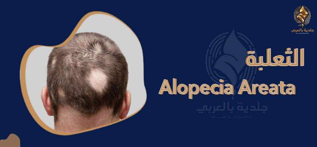 انواع الثعلبة | هل تتحول الثعلبة البقعية إلى شاملة؟