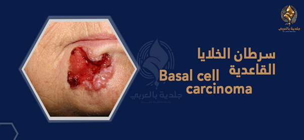 سرطان الخلايا القاعدية (basal cell carcinoma)