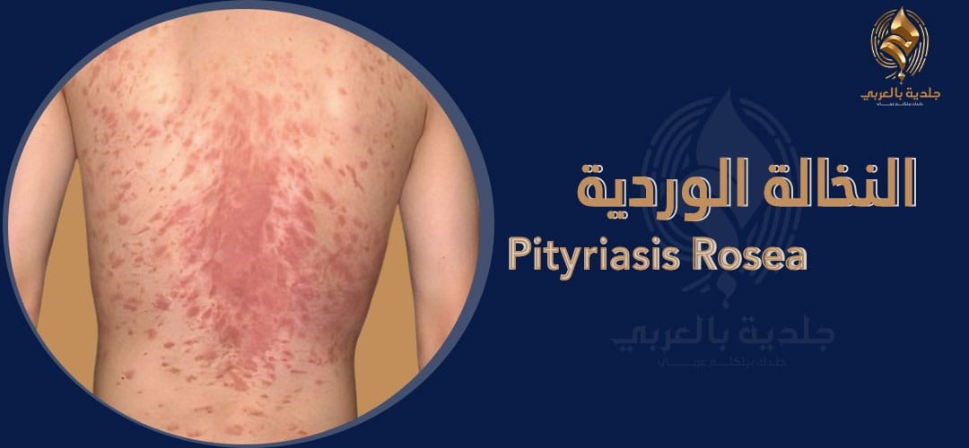 ما بين أسباب النخالة الوردية و علاجها