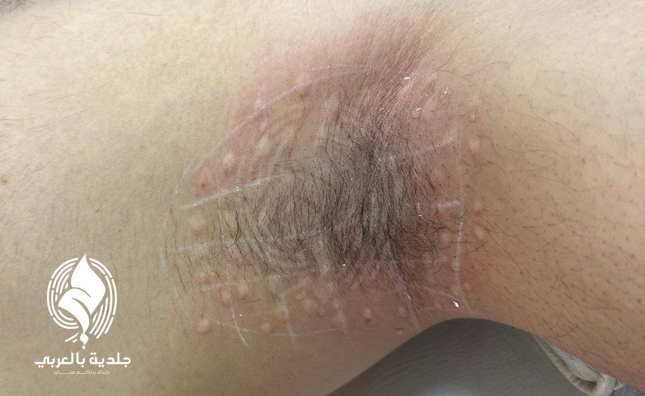 علاج التعرق الزائد