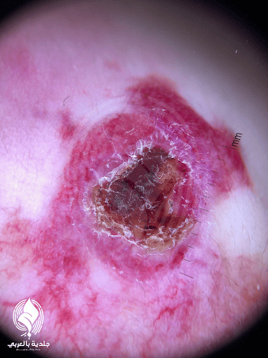 الورم الوعائي الدموي