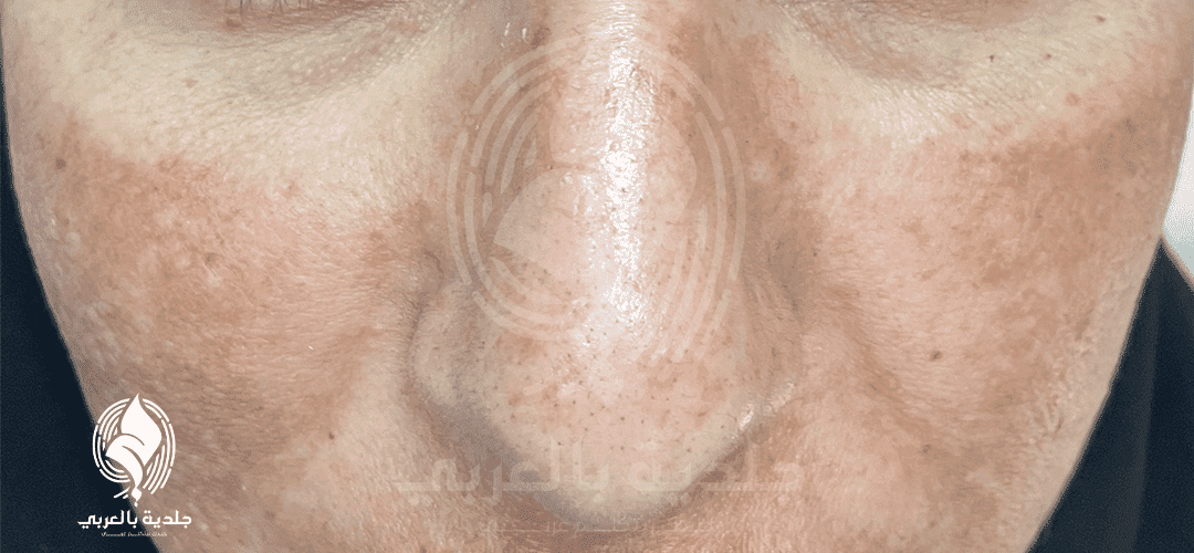 اعراض الكلف