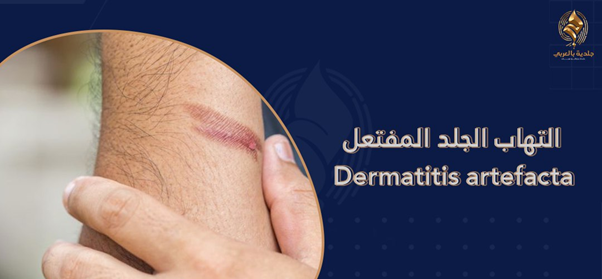 التهاب الجلد المفتعل Dermatitis artefacta | الأسباب النفسية والعلاج