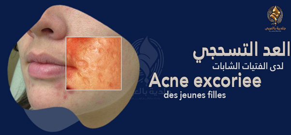 العد التسحجي (Acne Excoriee) | ما هو حب الشباب العصبي السحجي وما هي أسبابه وطرق العلاج والوقاية