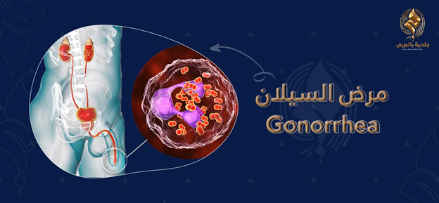 تعرف على شكل إفرازات السيلان، ما هي أسبابه وكيفية علاجه؟