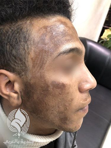 ما هي مضاعفات التقشير الكيميائي؟