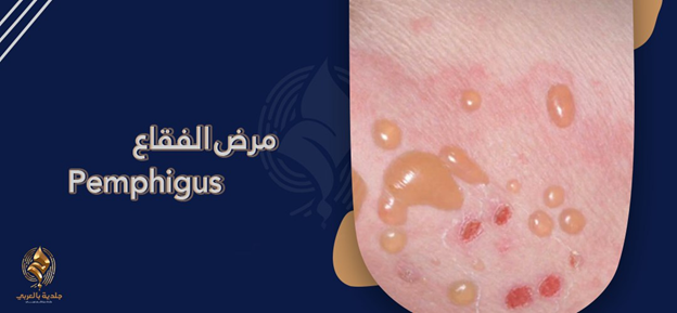 مرض الفقاع pemphigus| هل مرض الفقاع الجلدي معدي؟ وهل يمكن الشفاء منه؟