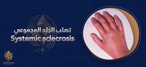 تصلب الجلد أو التصلب المجموعي (Systemic Sclerosis)| تعرف على أنواع تصلب الجلد، وأسبابه وطرق العلاج