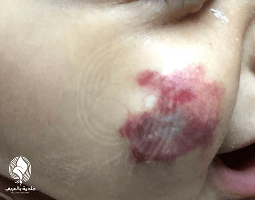 الورم الوعائي الدموي