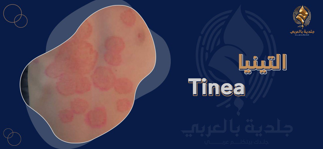 ما هي التينيا؟ وما أعراضها؟