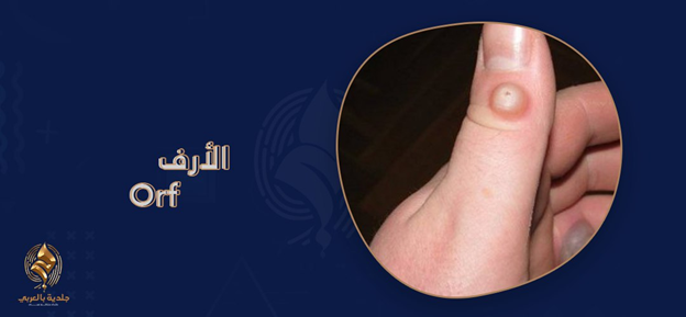 أورف (orf disease)… ما هو، وكيف تتعرف إليه؟