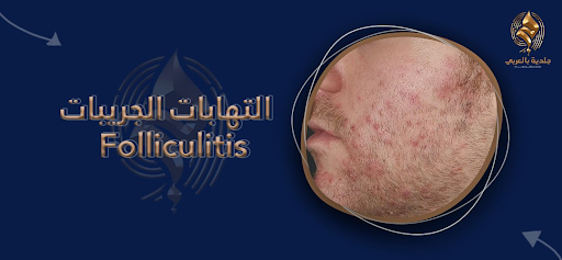 ما لا تعرفه عن الالتهاب الجريبي