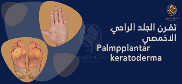 تقرن الجلد الراحي الاخمصي (Palmoplantar keratoderma)