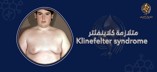 العقم ومتلازمة كلاينفلتر | الأسباب والعلاج