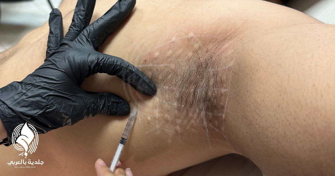 علاج التعرق الزائد