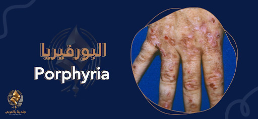 مرض البورفيريا I رحلة في عالم هذا المرض النادر