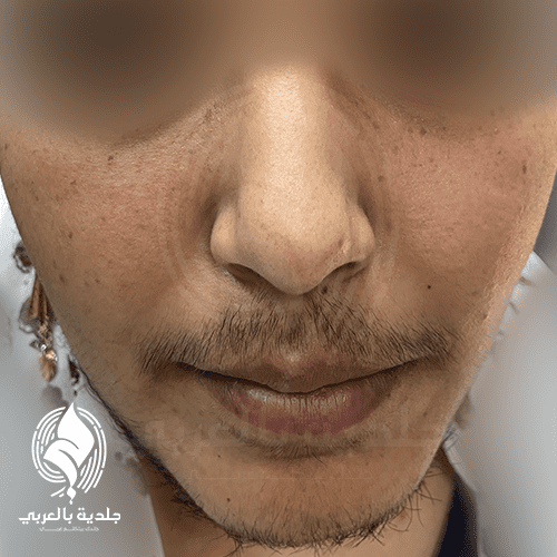 أعراض الإصابة بالشعرانية Hirsutism