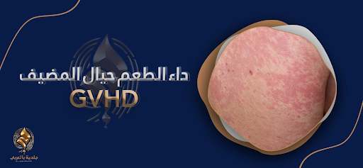 داء الطُعم حيال المُضيف (GVHD)| ماذا بعد عملية زرع الخلايا الجذعية؟
