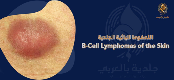 لمفومة الخلايا البائية الجلدية (cutaneous b-cell lymphoma) | بين أنواعها وطرق علاجها