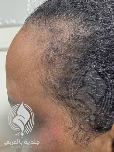 أنواع الصلع