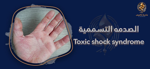 الصدمة التسممية (Toxic shock syndrome)|ما هي؟ وكيفية علاجها؟