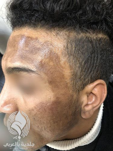 ما هي مضاعفات التقشير الكيميائي؟