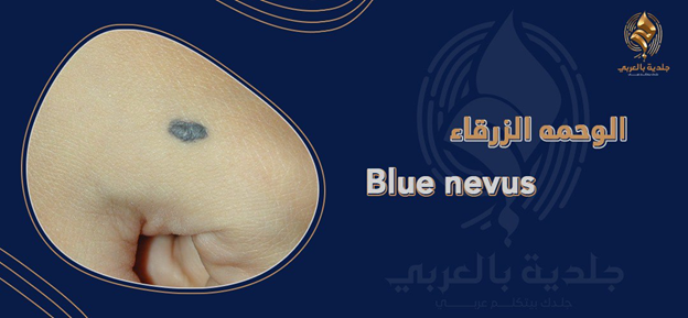 الوحمة العصبية (Blue nevus) أو الزرقاء وأشكالها المختلفة