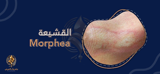 تعرف أكثر عن القشيعة (morphea)