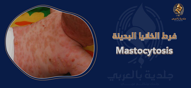 ما هي كثرة الخلايا البدينة Mastocytosis؟ وهل يمكن علاجها؟