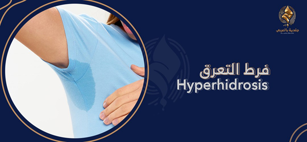 ما هي اسباب زيادة التعرق hyperhidrosis | وكيف نتغلب عليها؟