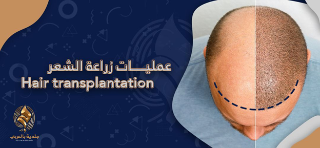 ما علامات فشل زراعة الشعر ونجاحها التي يمكن أن تلاحظها؟