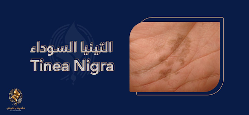 ما هي السعفة السوداء؟