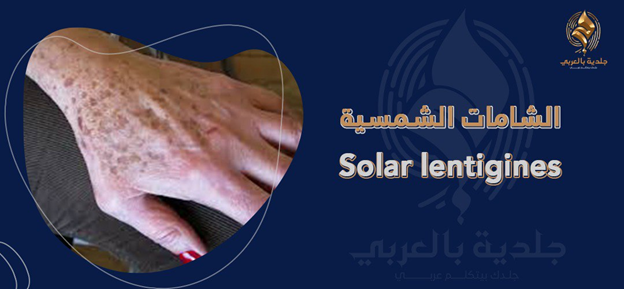 ما هي الشامات الشمسية؟ وما علاقتها بأشعة الشمس الضارة؟