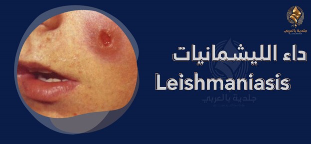 داء الليشمانيات leishmaniasis | ما هي ليشمانيا الجلد؟ وأهم الأنواع بالصور