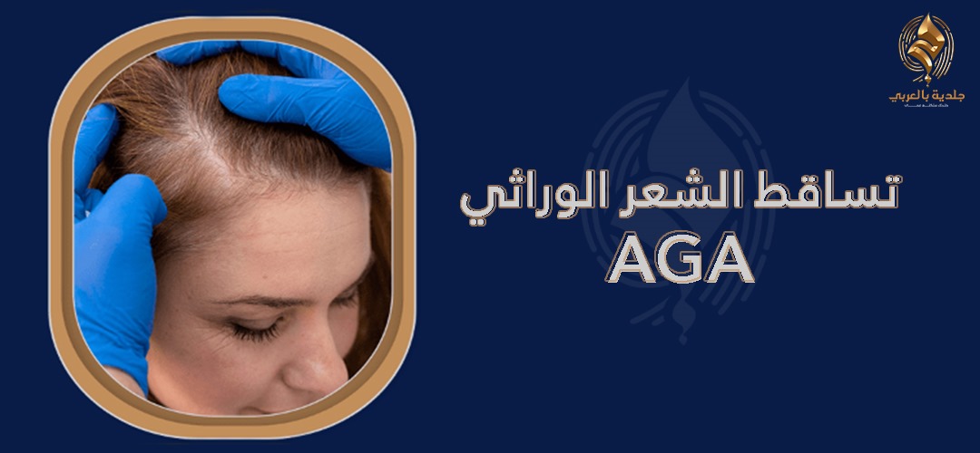 علامات الصلع الوراثي | هل يمكن أن تتوقف؟