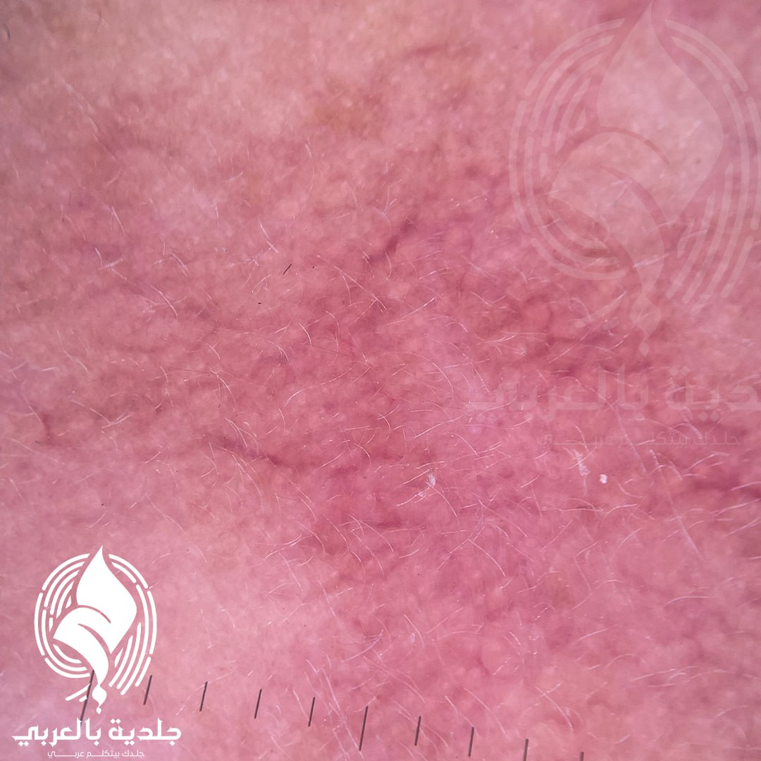 التشخيصات التفريقية لمرض الوردية