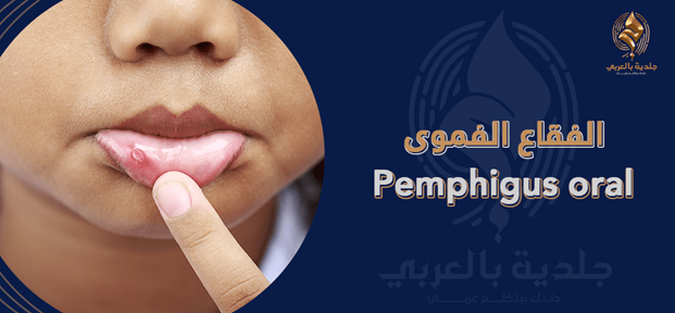 الفقاع الفموي oral pemphigus| الأسباب والأعراض وطرق العلاج
