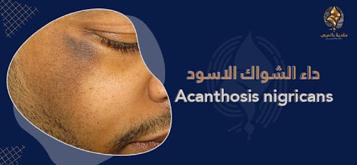 الشواك الأسود Acanthosis nigricans | اسبابه وأساليب الوقاية والعلاج