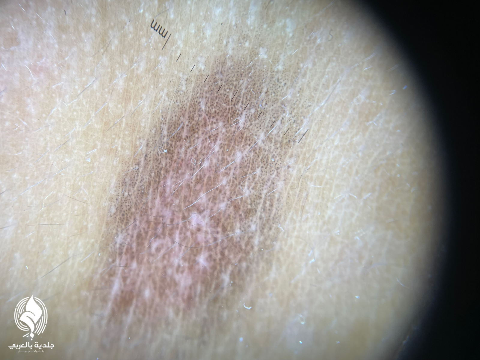 الاكزيما بالصور