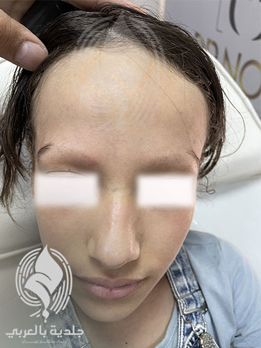 اعراض الثعلبة