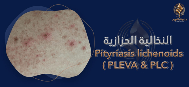 Pityriasis lichenoides| النخالة الحزازية بين الحاد والمزمن وأساليب العلاج