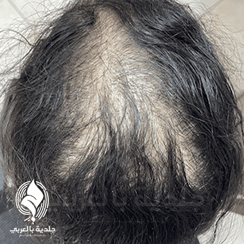 علامات الصلع الوراثي