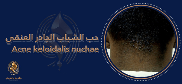 حب الشباب الجادر العنقي القفوي