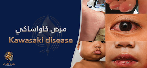 مرض كاواساكي | أعراضه وأسبابه | وأساليب علاجه