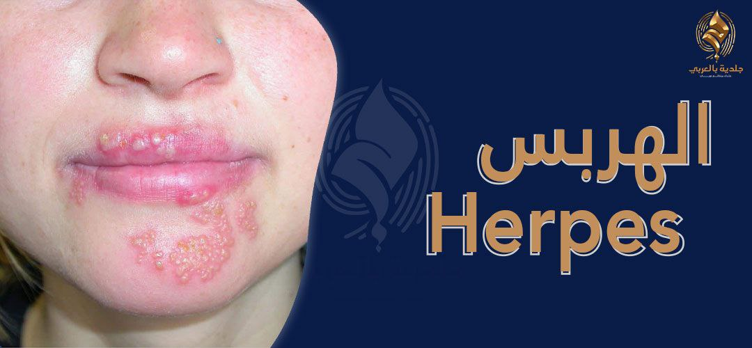أنواع الهربس: الأعراض، الأسباب، طرق الوقاية والعلاج